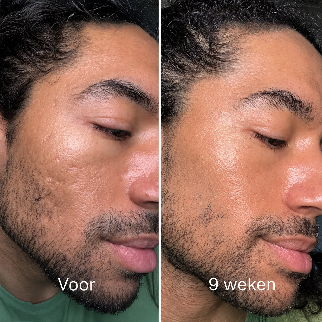 ScarStick™ | Voor acnelittekens, operatiescars en striae. Klinische werking, thuis