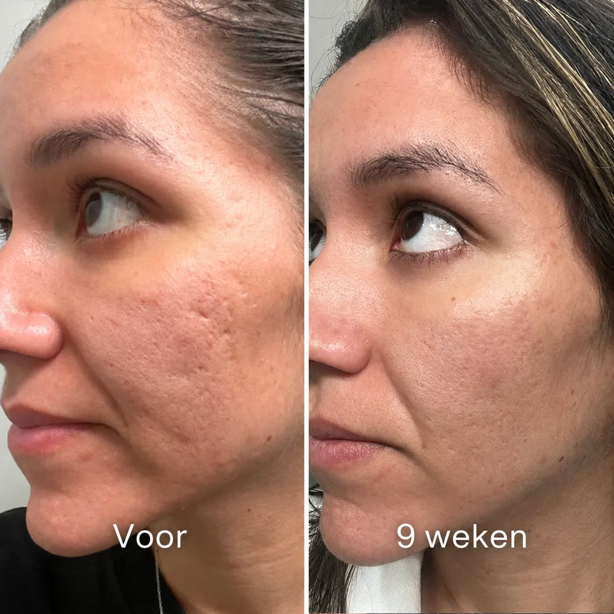 ScarStick™ | Voor acnelittekens, operatiescars en striae. Klinische werking, thuis