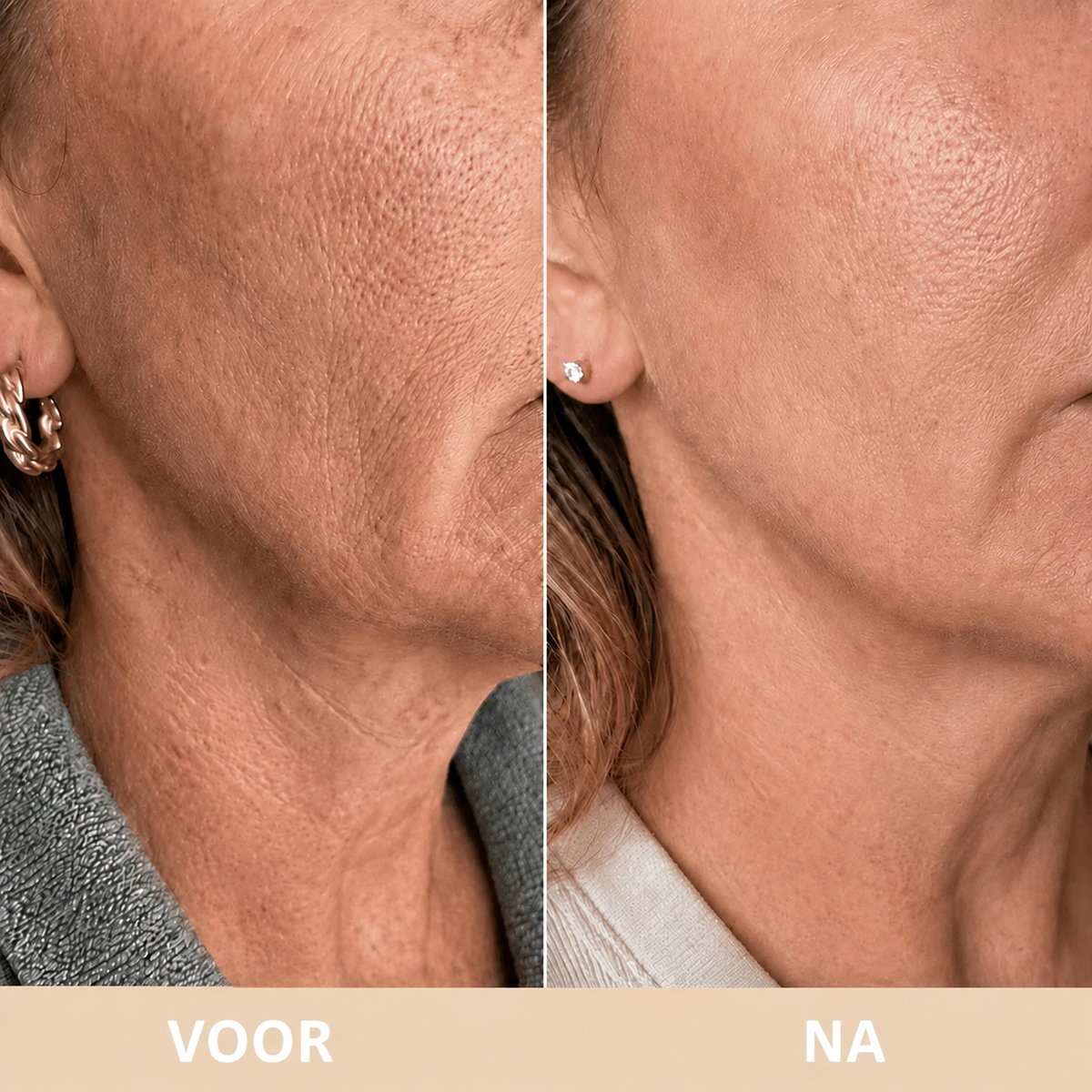 SculptLift™ | Voor een strakkere kaaklijn en gladdere hals