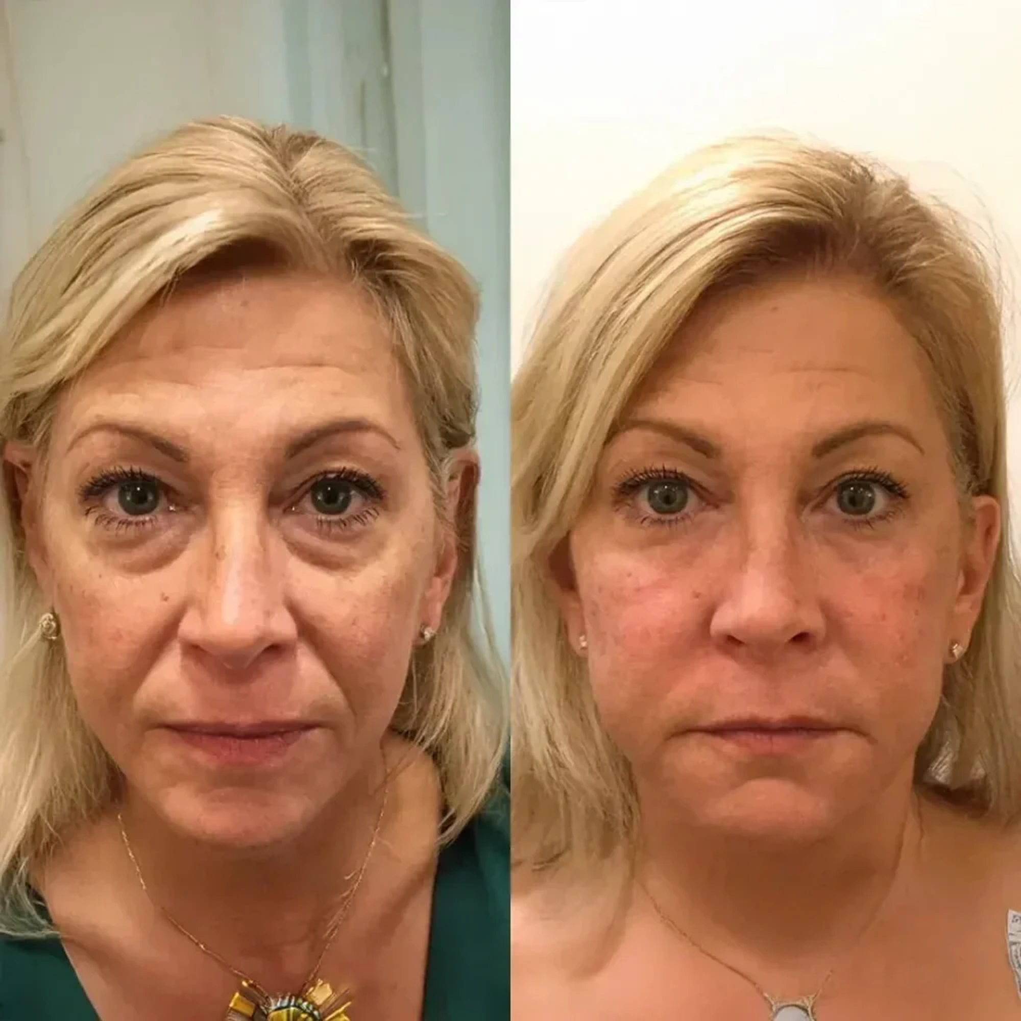 NoraSkin™ | Instant V-Lift