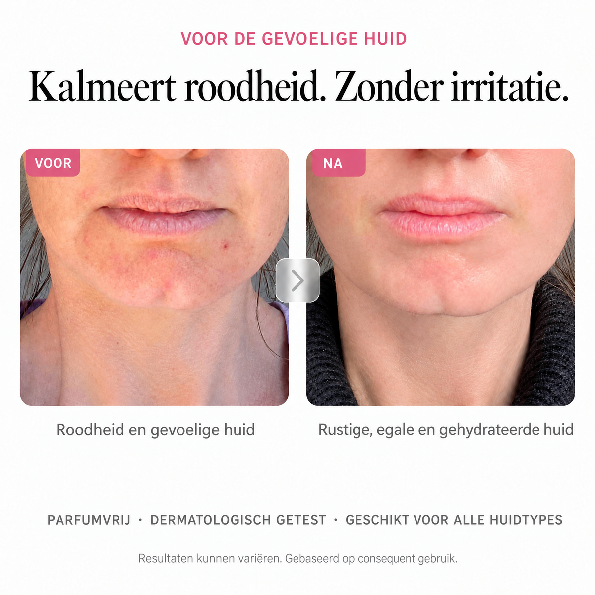 Kalmeert roodheid