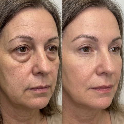 EyeLifted™ | Your 90-Second Eye Transformation