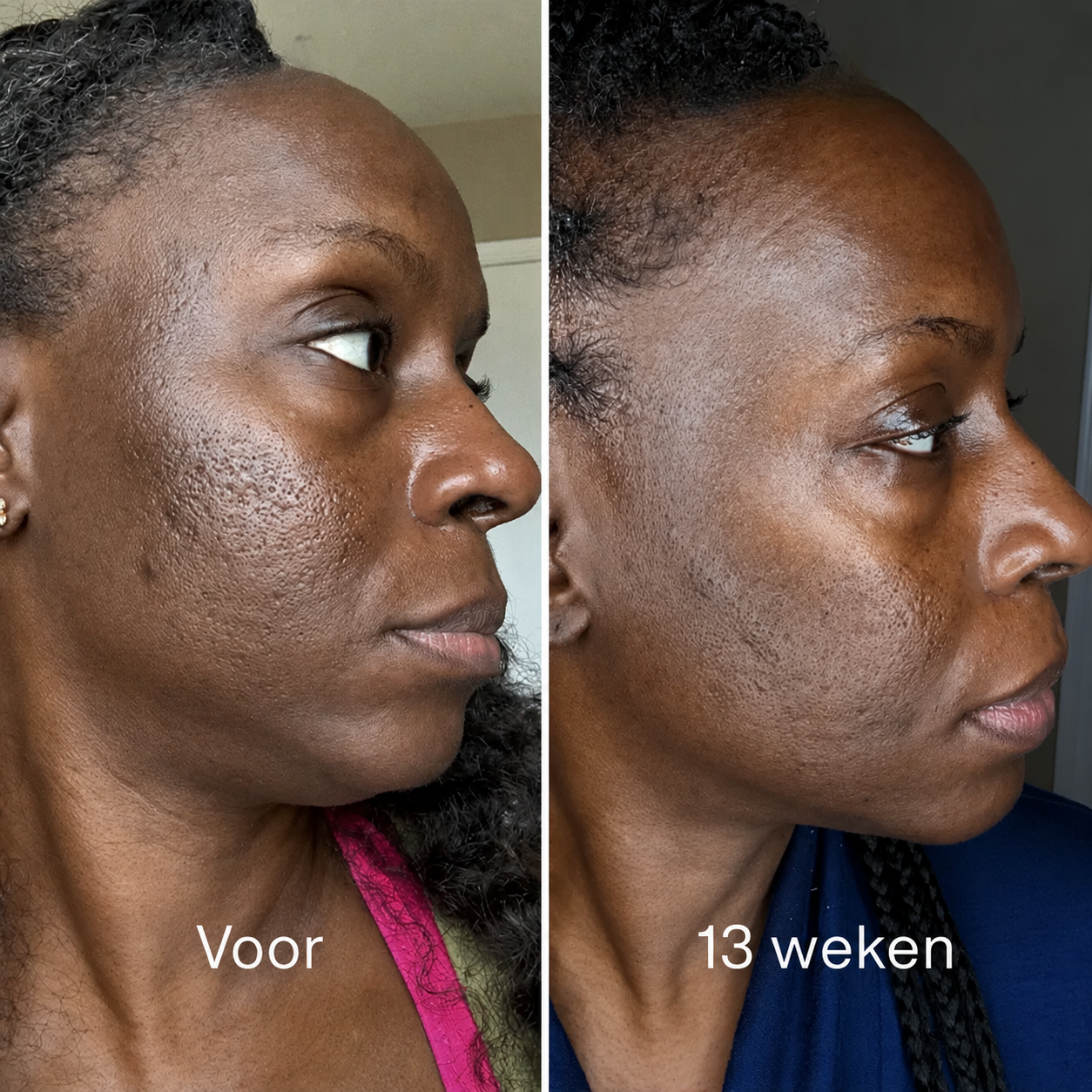 ScarStick™ | Voor acnelittekens, operatiescars en striae. Klinische werking, thuis
